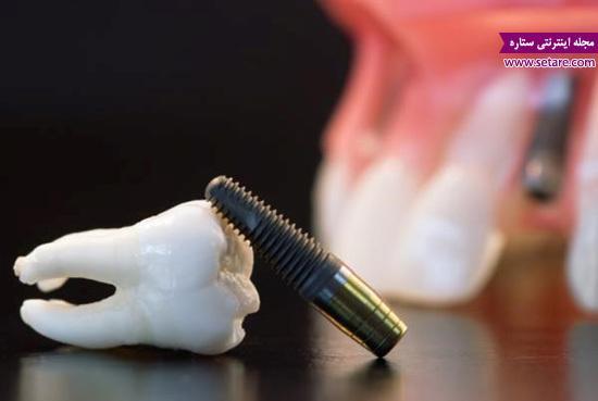 ایمپلنت دندان؛ همه چیز درباره جایگزینی و کاشت دندان