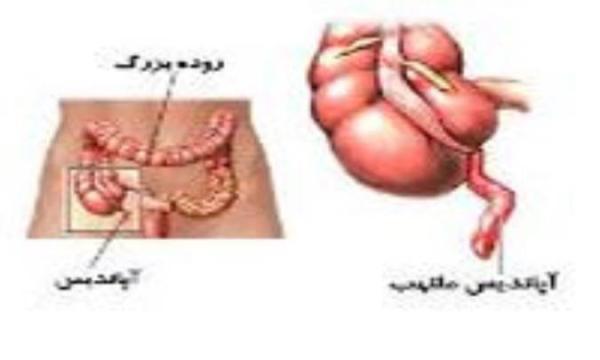 آپاندیس در چه قسمتی از بدن قرار گرفته است؟